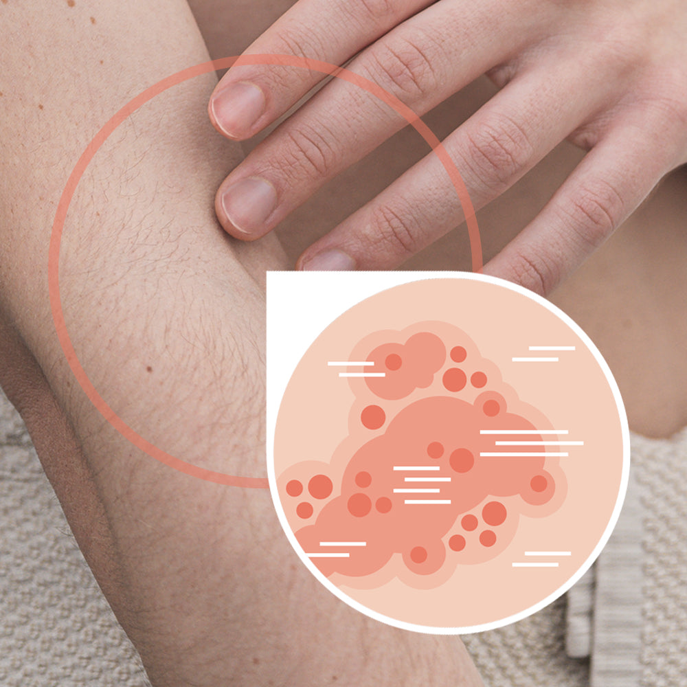 Hautkrankheit Neurodermitis