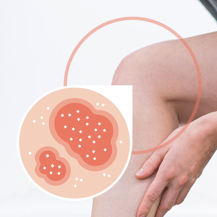 Hautkrankheit Schuppenflechte